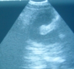  scan showing foetus and gestational sac